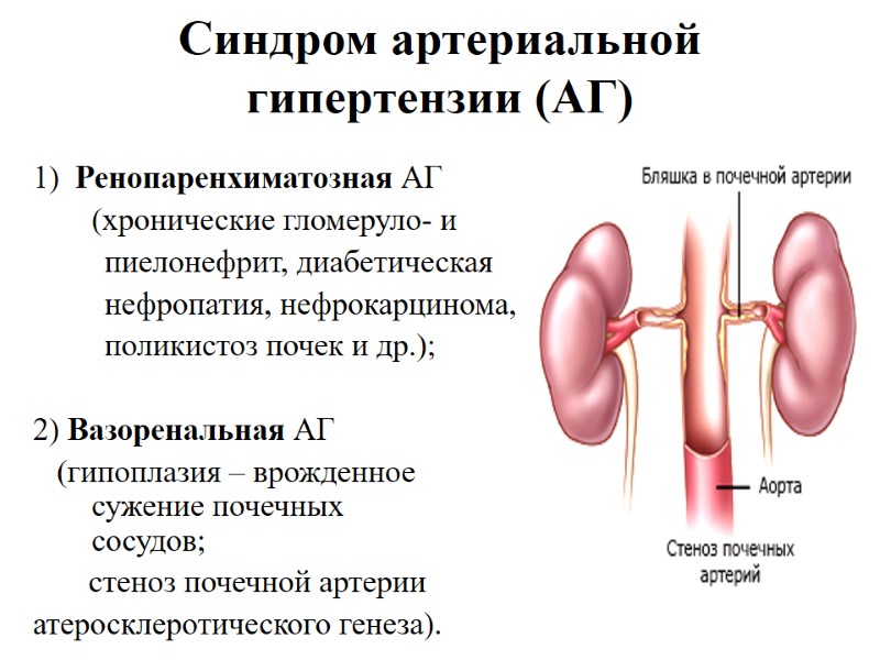 Синдром артериальной гипертензии (АГ) 1)  Ренопаренхиматозная АГ   (хронические гломеруло- и 